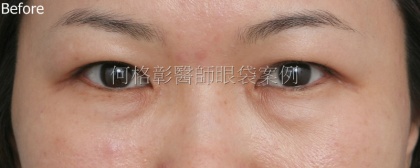 眼袋手術-15