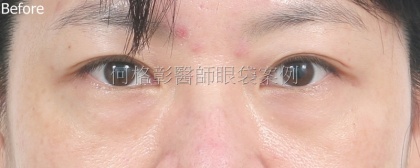 眼袋手術-16