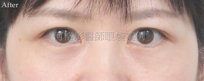 眼袋手術-19