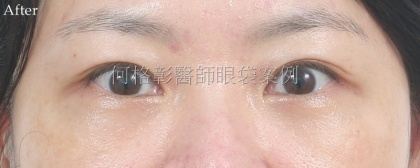 眼袋手術-20