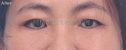 眼袋手術-24