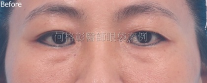 眼袋手術-25