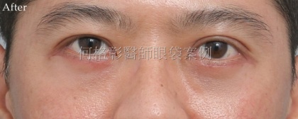 眼袋手術-28