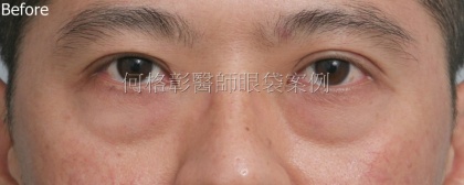 眼袋手術-29