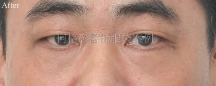 眼袋手術-30