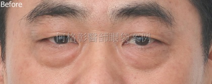 眼袋手術-31