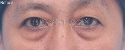 眼袋手術-32