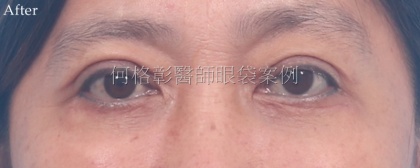 眼袋手術-33