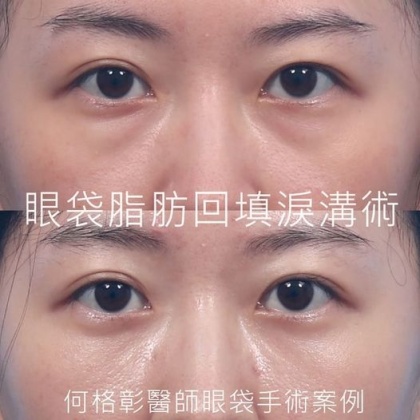 眼袋手術-34