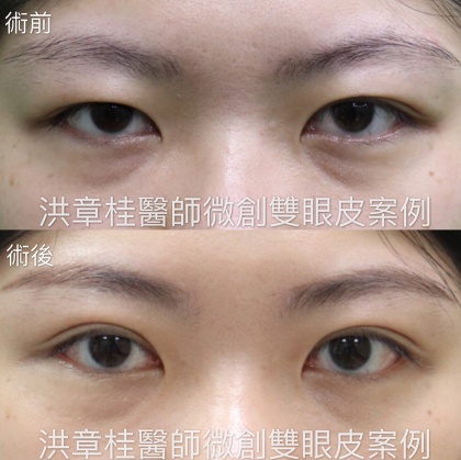 縫雙眼皮手術-28