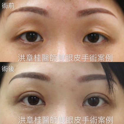 縫雙眼皮手術-30
