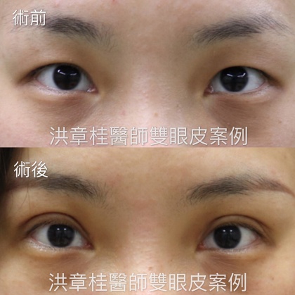 縫雙眼皮手術-33