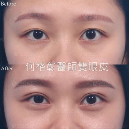 縫雙眼皮手術-49