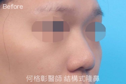 結構式隆鼻-73