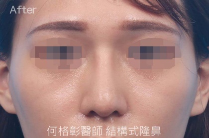 結構式隆鼻-74
