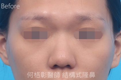 結構式隆鼻-107