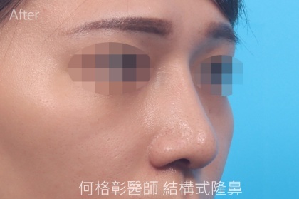 結構式隆鼻-108