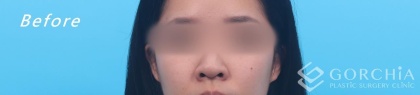 縮鼻翼/鼻孔手術-3