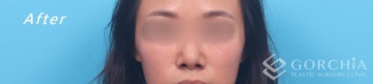 縮鼻翼/鼻孔手術-6