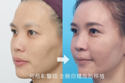 自體脂肪補脂手術-4