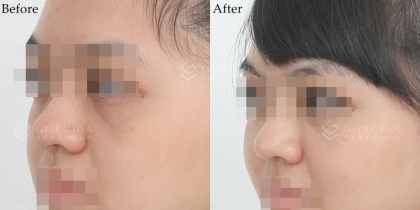 自體脂肪補脂手術-8