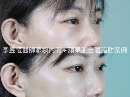 自體脂肪補脂手術-10