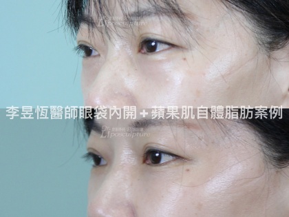 自體脂肪補脂手術-11