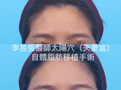 自體脂肪補脂手術-15