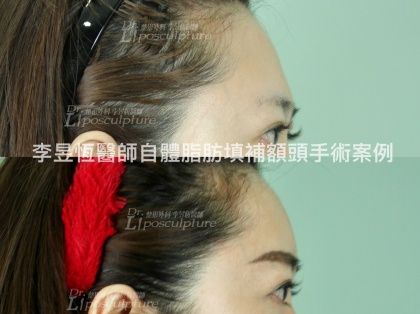 豐額手術-3