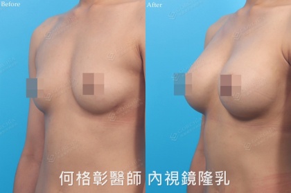 內視鏡隆乳-13