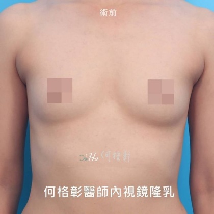 內視鏡隆乳-22