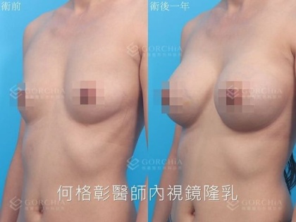 內視鏡隆乳-24