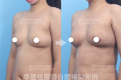 自體脂肪隆乳-2