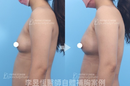自體脂肪隆乳-3