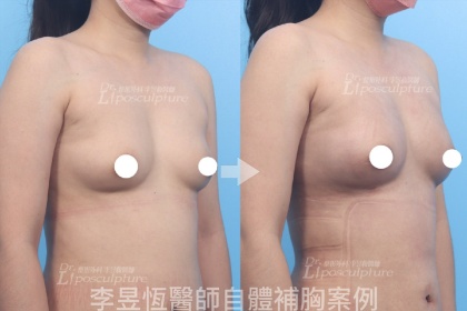 自體脂肪隆乳-4