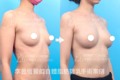 自體脂肪隆乳-7