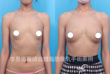 自體脂肪隆乳-10
