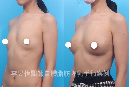 自體脂肪隆乳-11