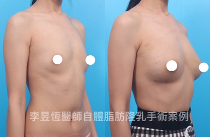 自體脂肪隆乳-12