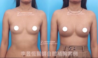 自體脂肪隆乳-13