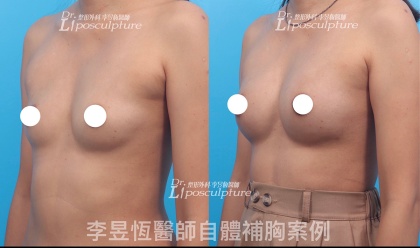 自體脂肪隆乳-14