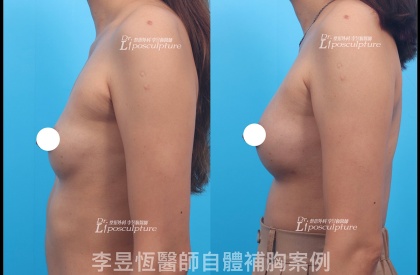 自體脂肪隆乳-15