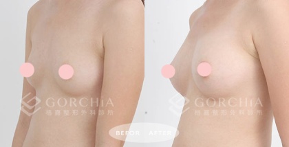 自體脂肪隆乳-20