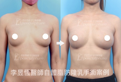 自體脂肪隆乳-21