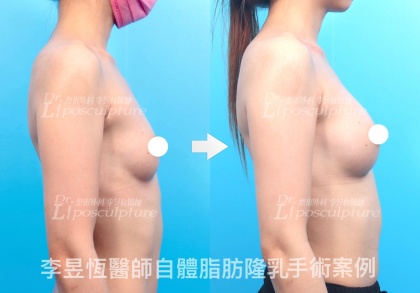 自體脂肪隆乳-22