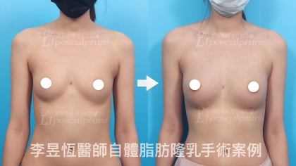 自體脂肪隆乳-23