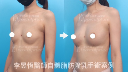 自體脂肪隆乳-24