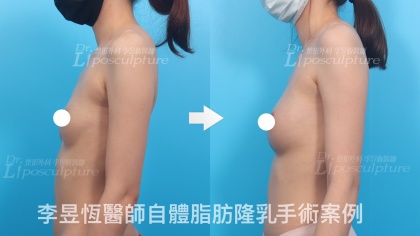 自體脂肪隆乳-25